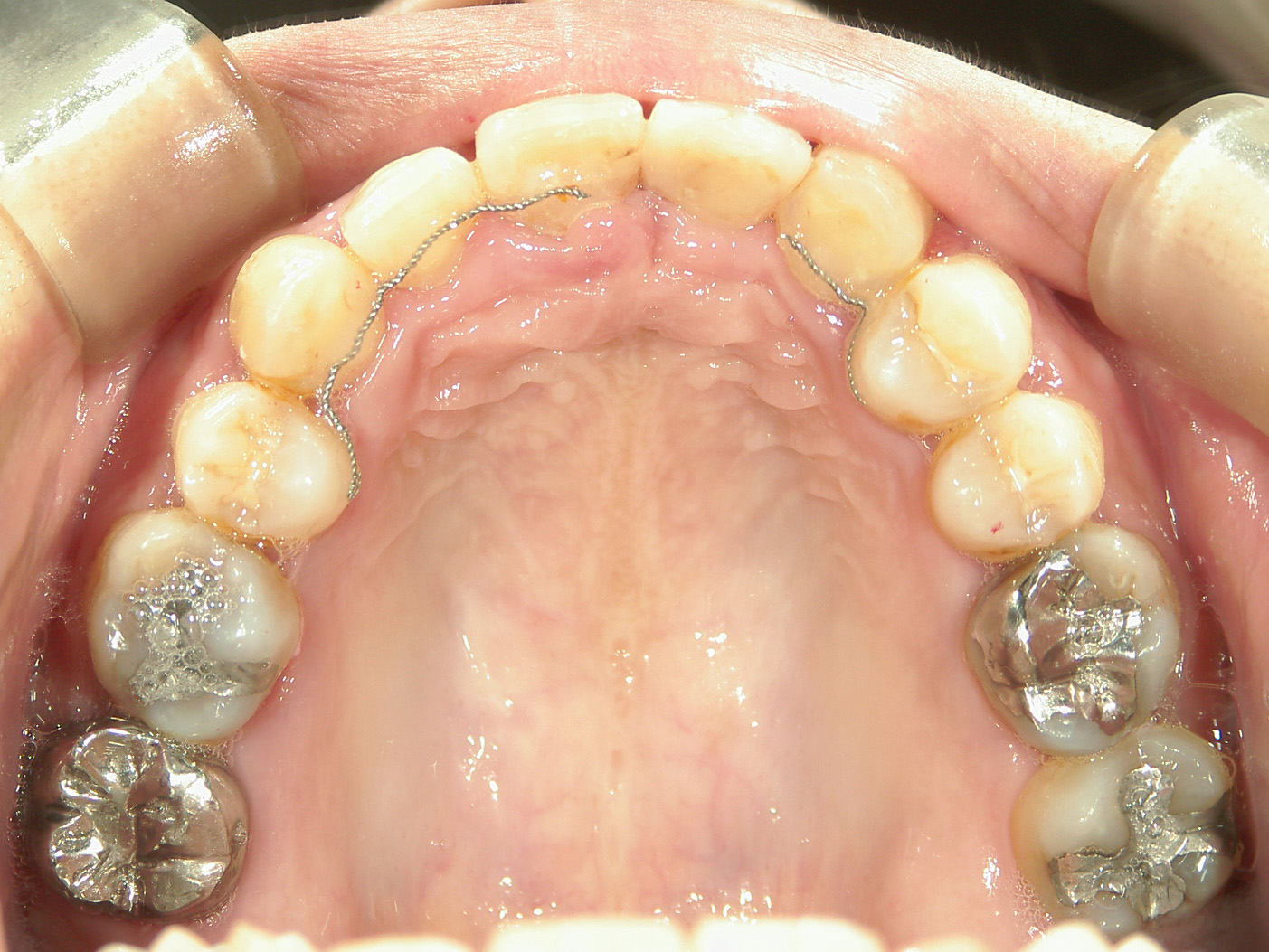 全顎ワイヤー矯正　症例（70）