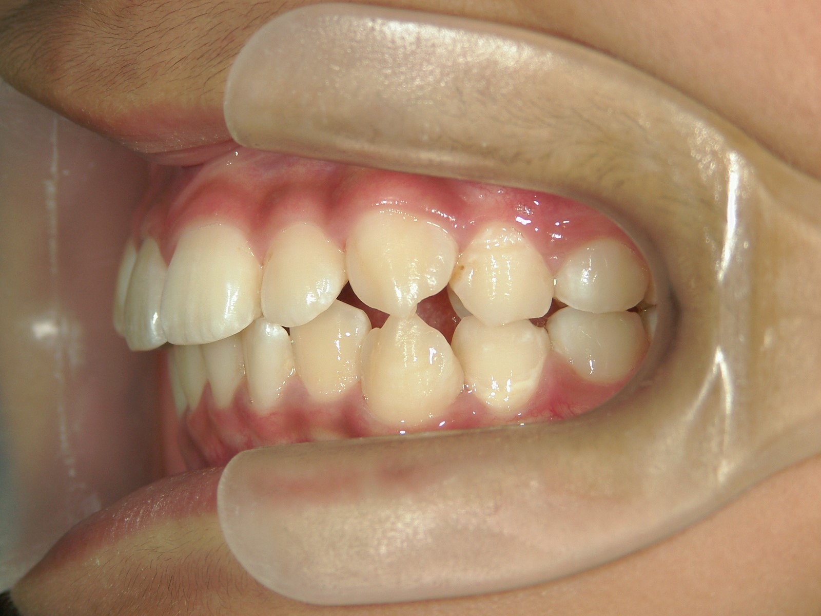 非抜歯症例（9）