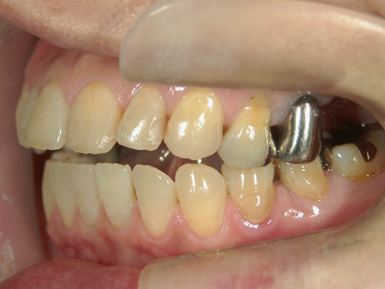 非抜歯症例（10）