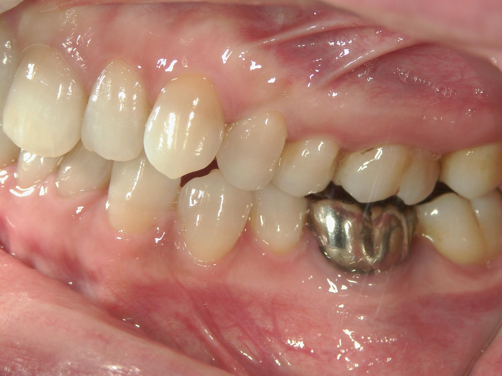 非抜歯症例（12）