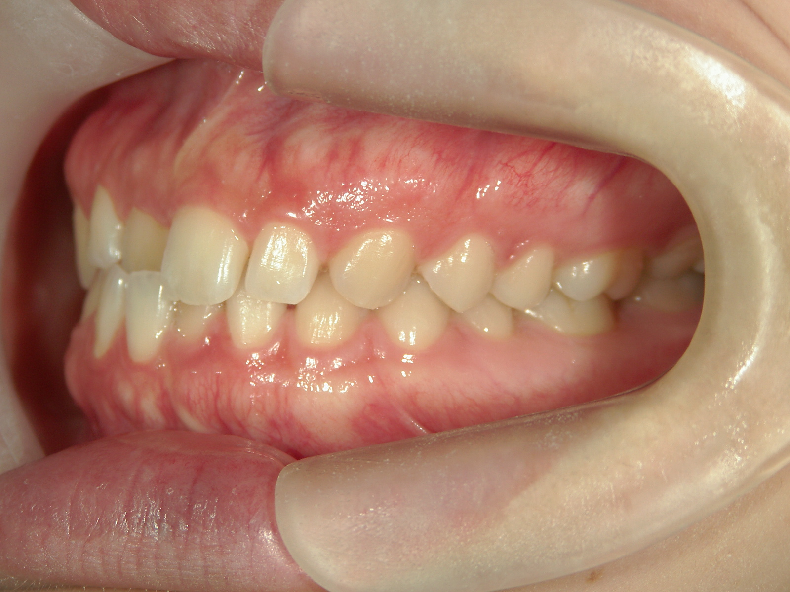 非抜歯症例（13）