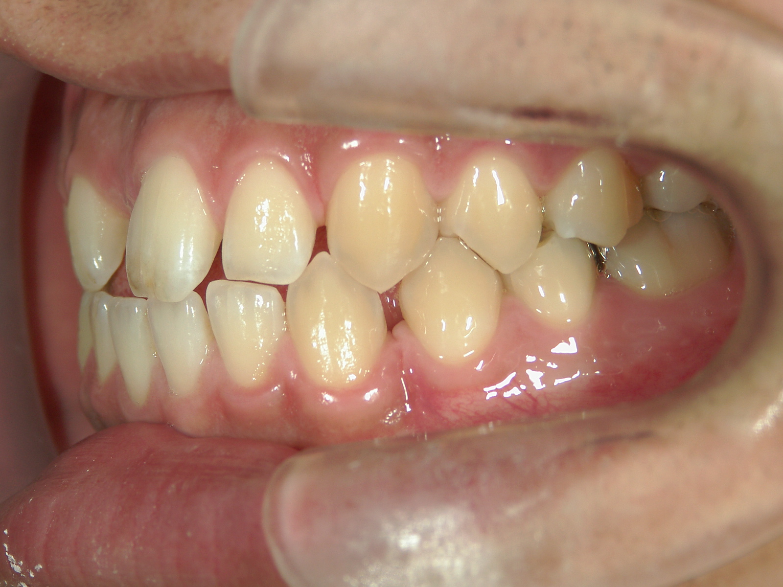 全顎ワイヤー矯正　症例（69）