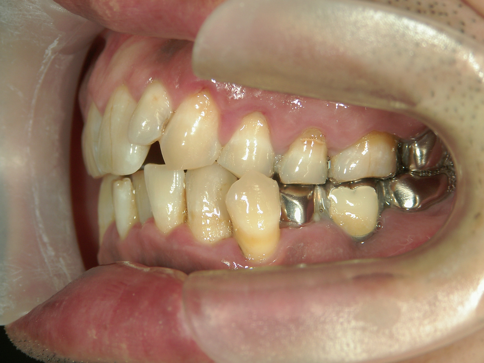 全顎ワイヤー矯正　症例（72）