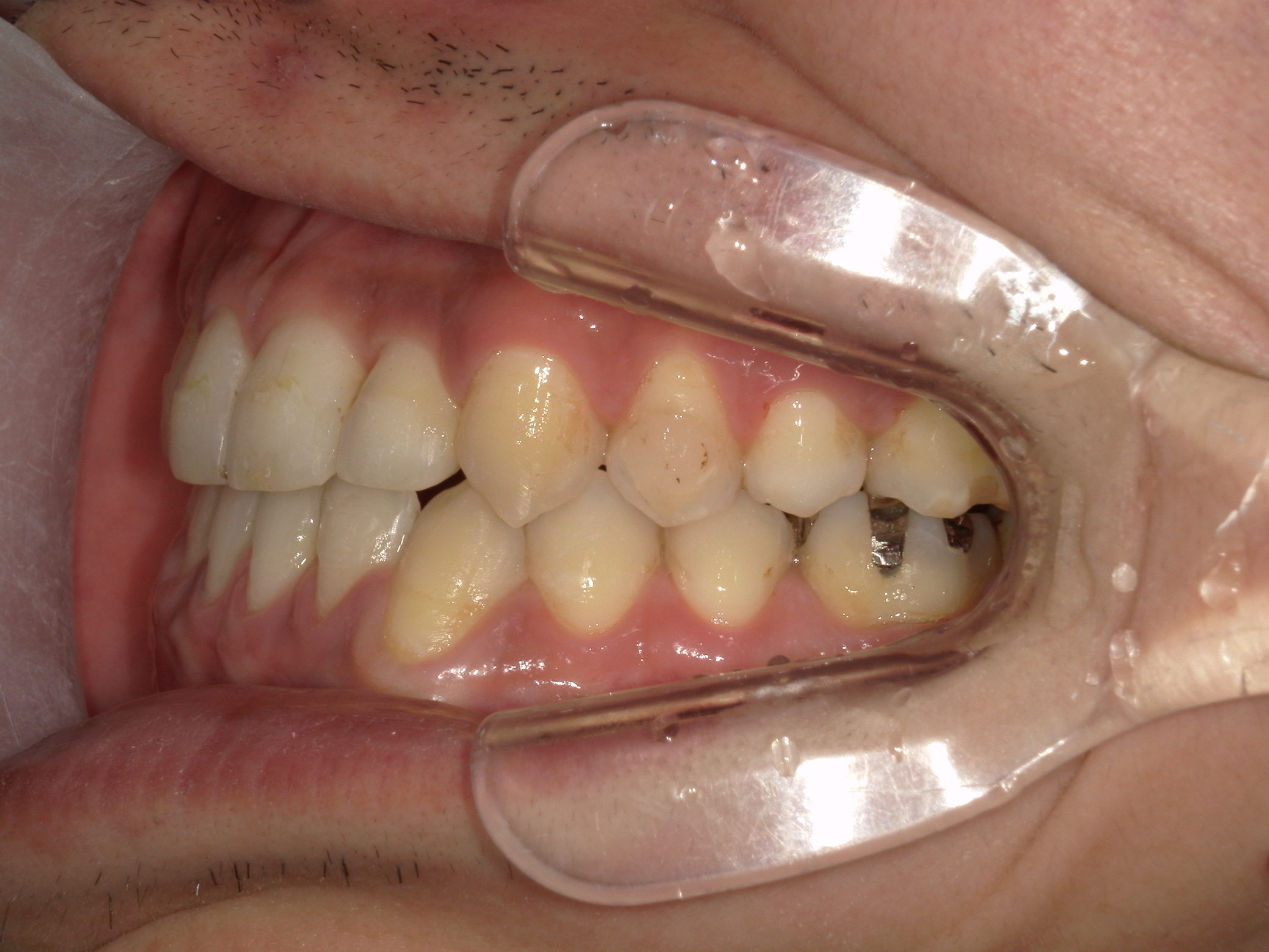 非抜歯症例（3）