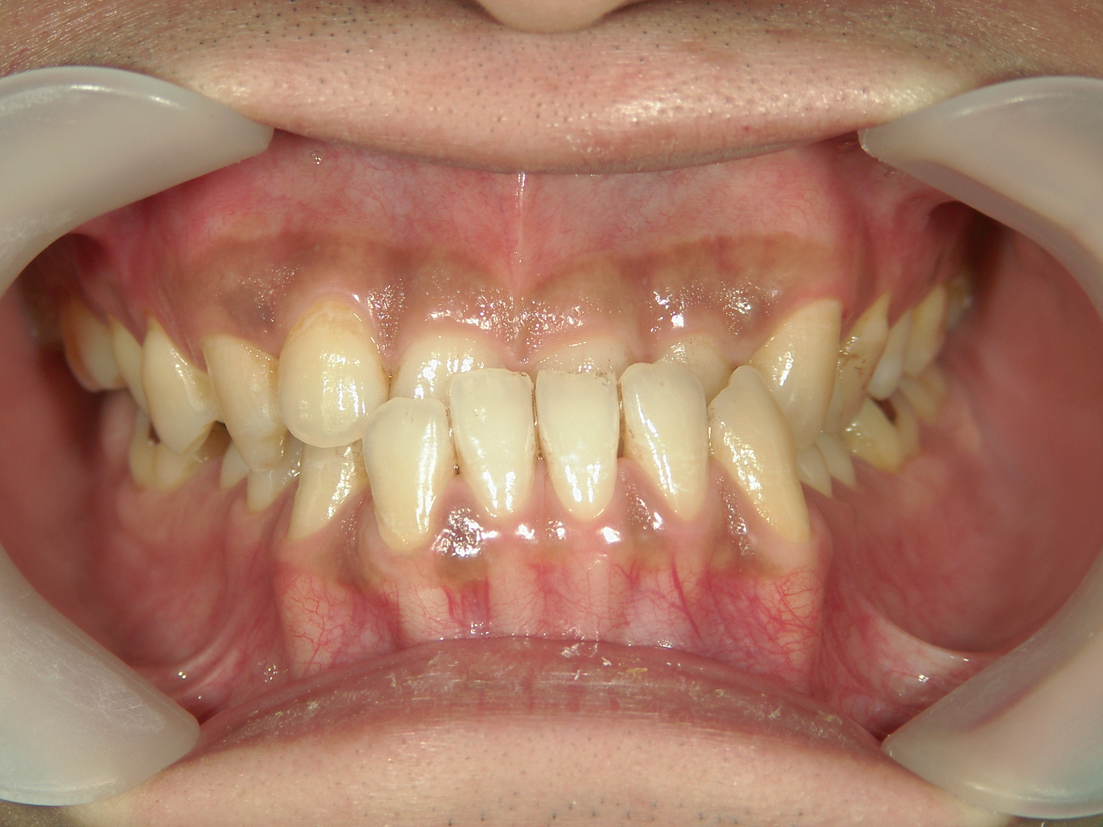 非抜歯症例（3）