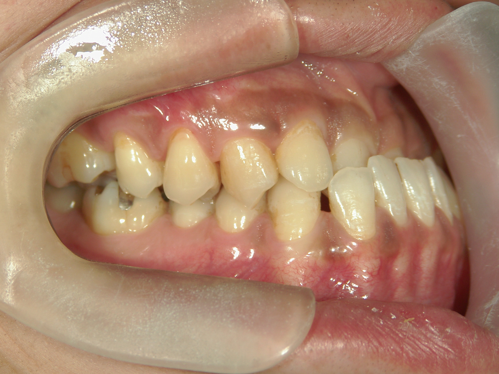 非抜歯症例（3） | 浜松市で矯正治療の期間のご相談ならいとう歯科矯正