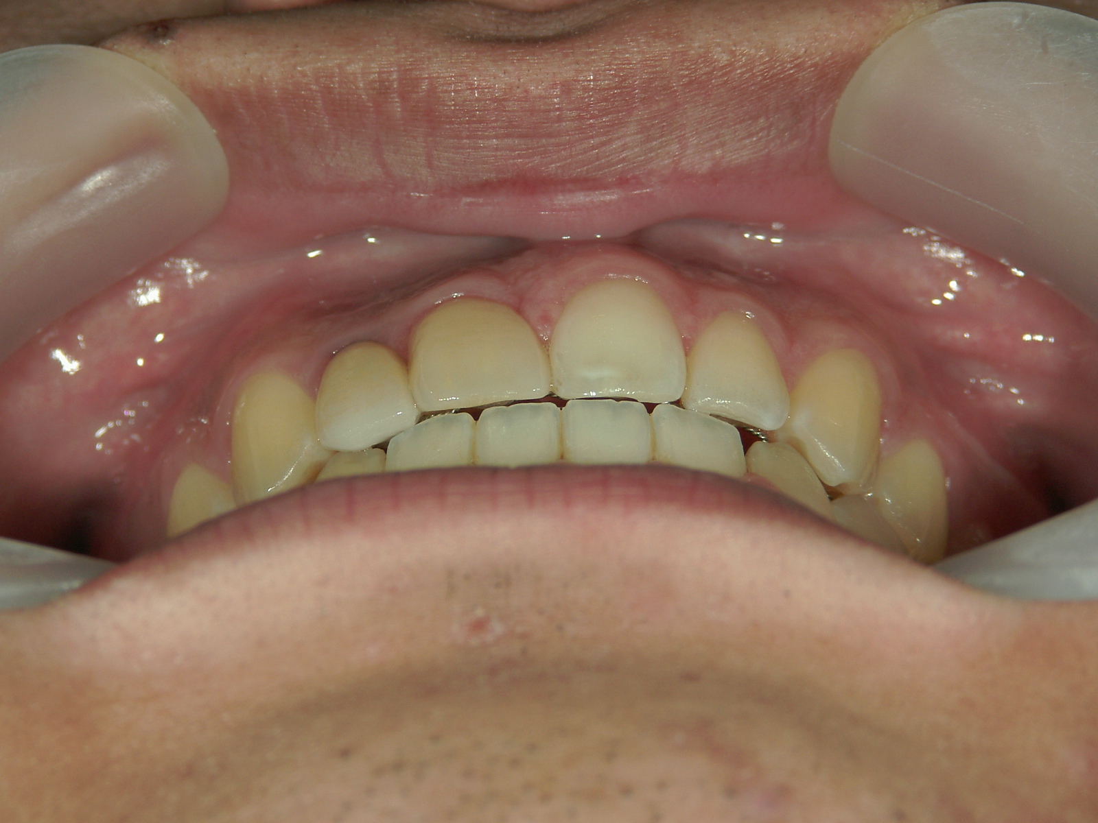 全顎ワイヤー矯正　症例（69）