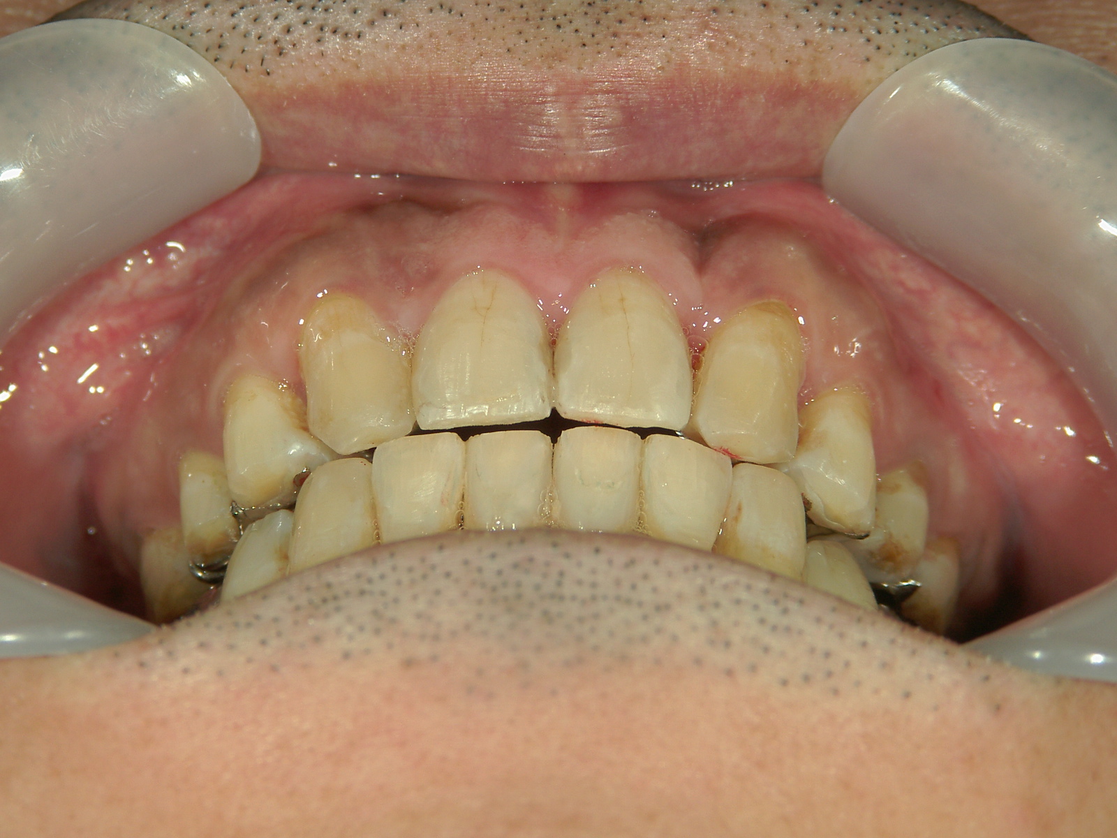 全顎ワイヤー矯正　症例（72）