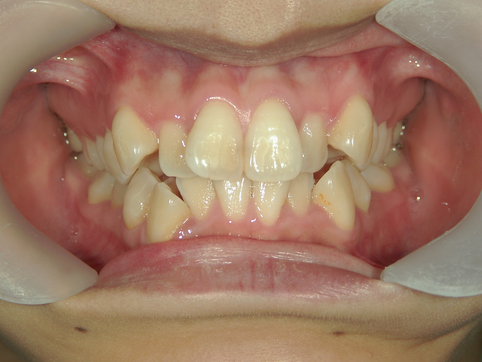 全顎ワイヤー矯正　症例（68）