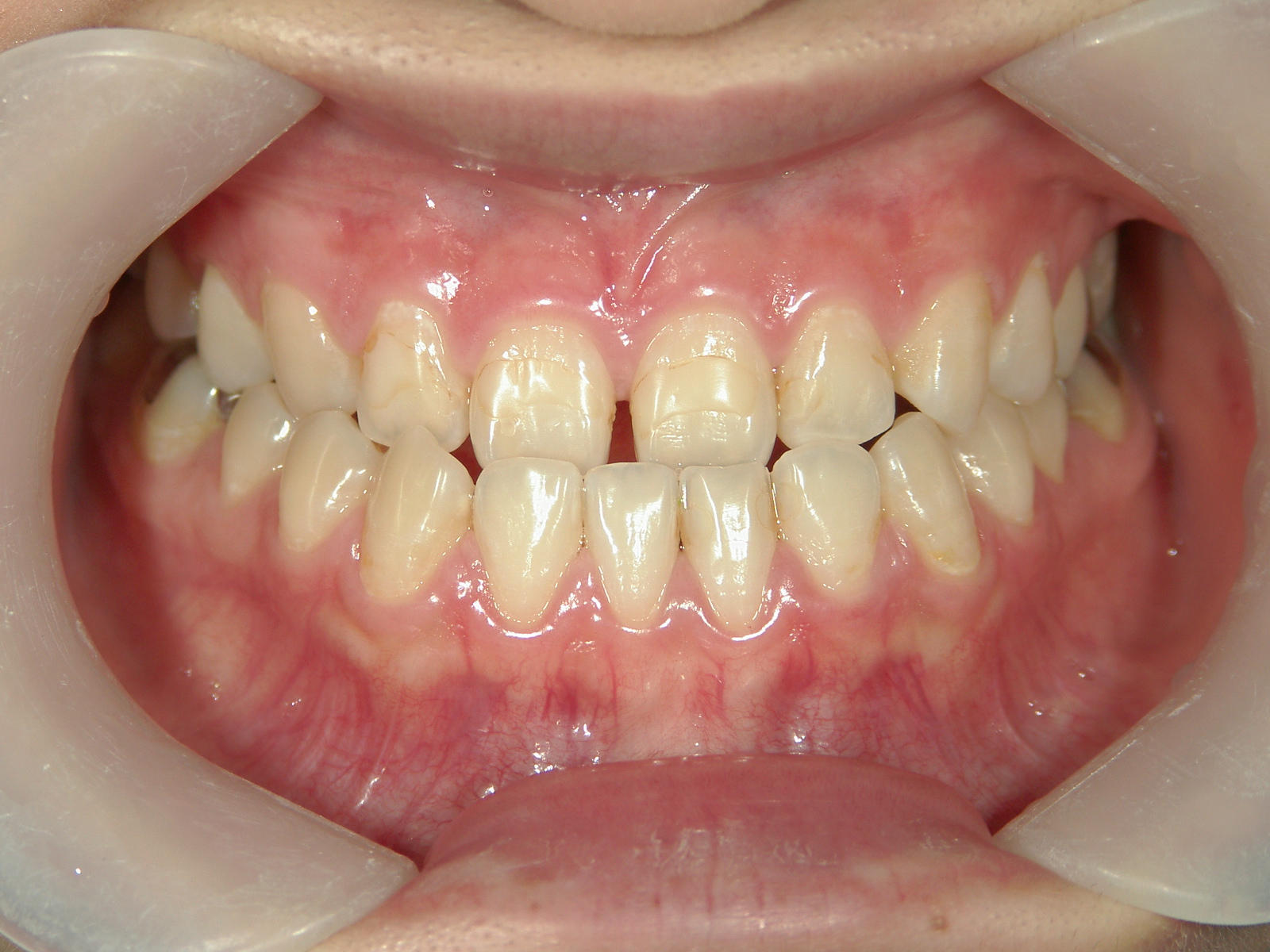 非抜歯症例（2）