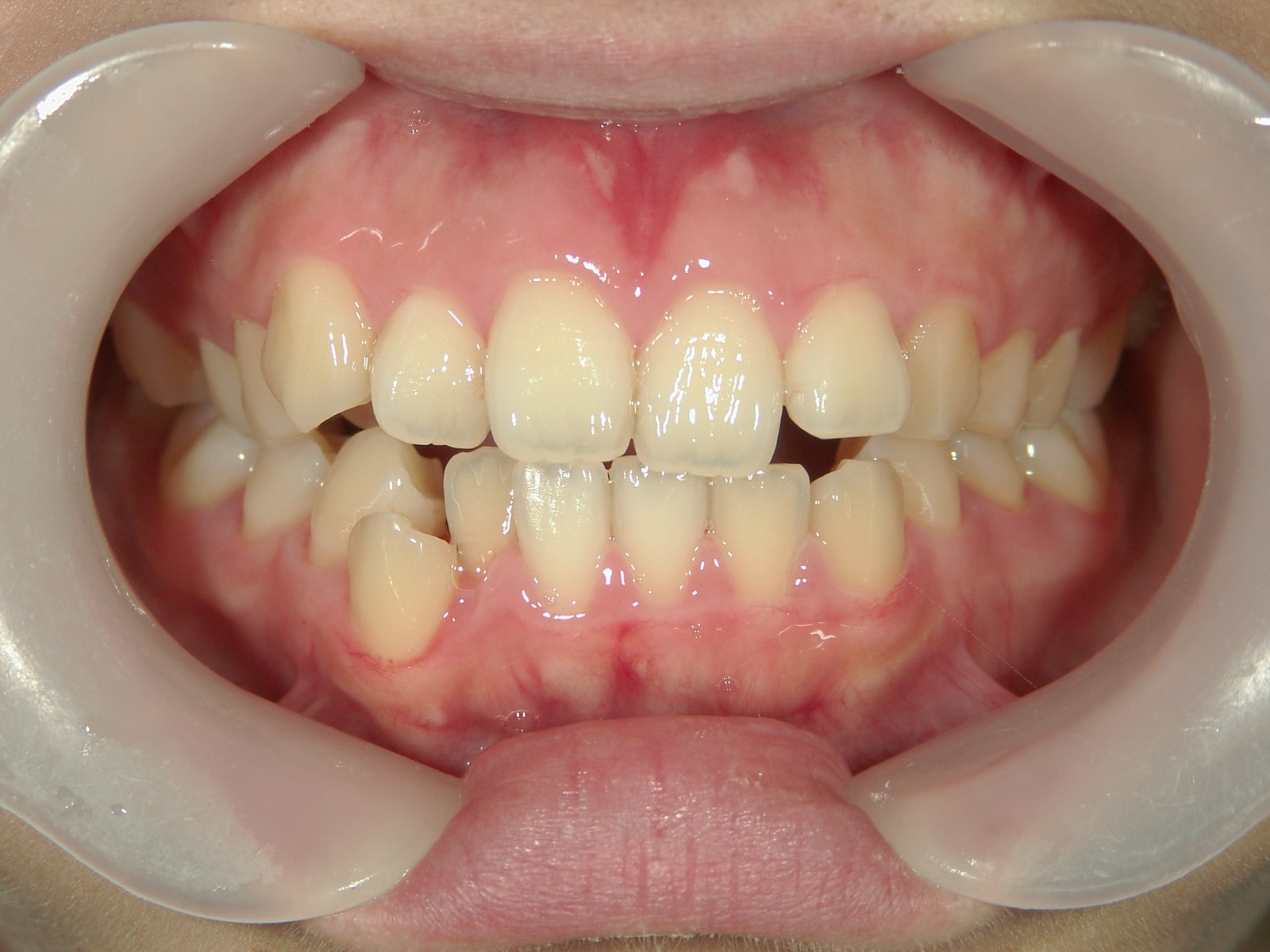 非抜歯症例（5）