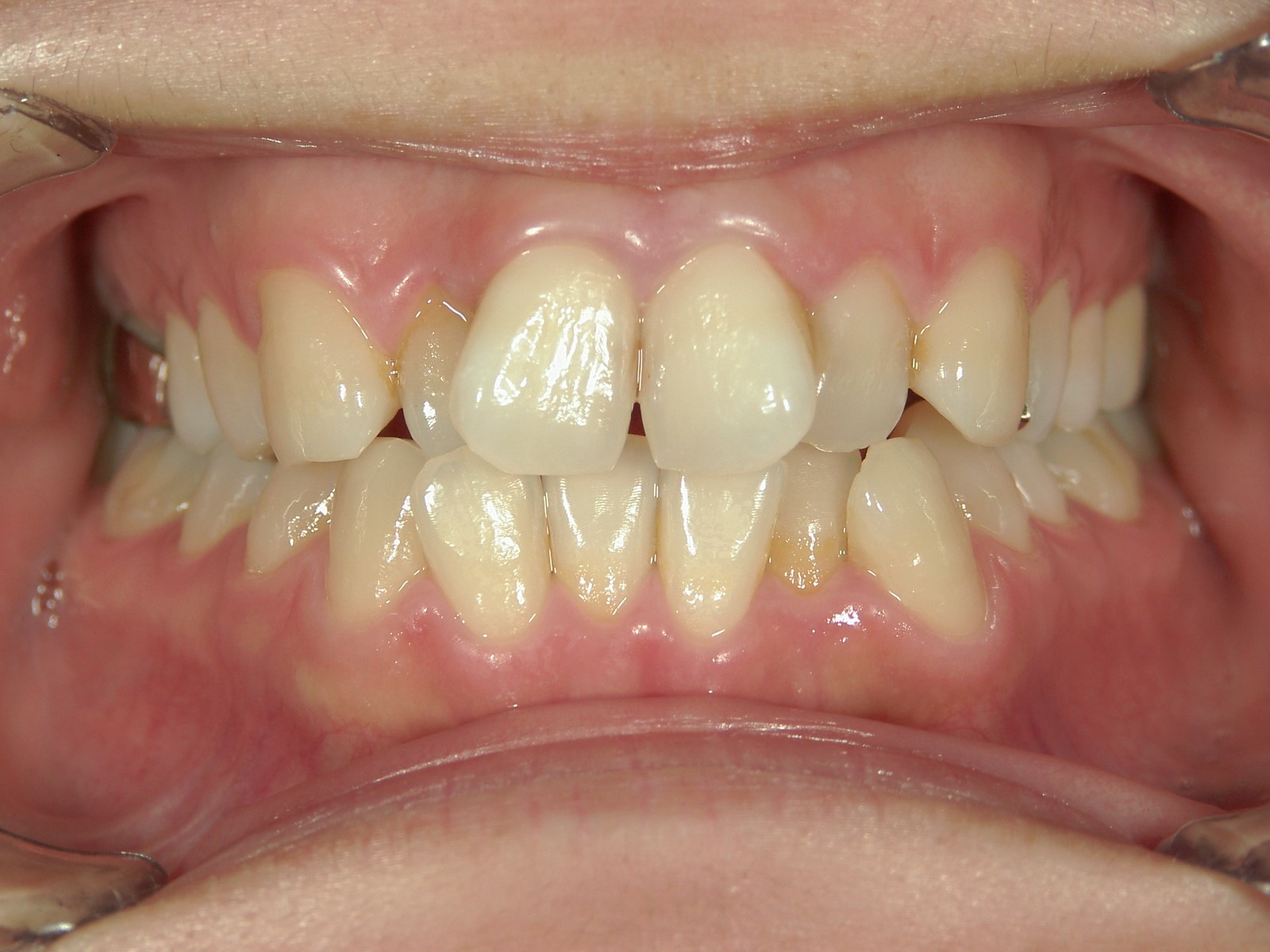 非抜歯症例（6）