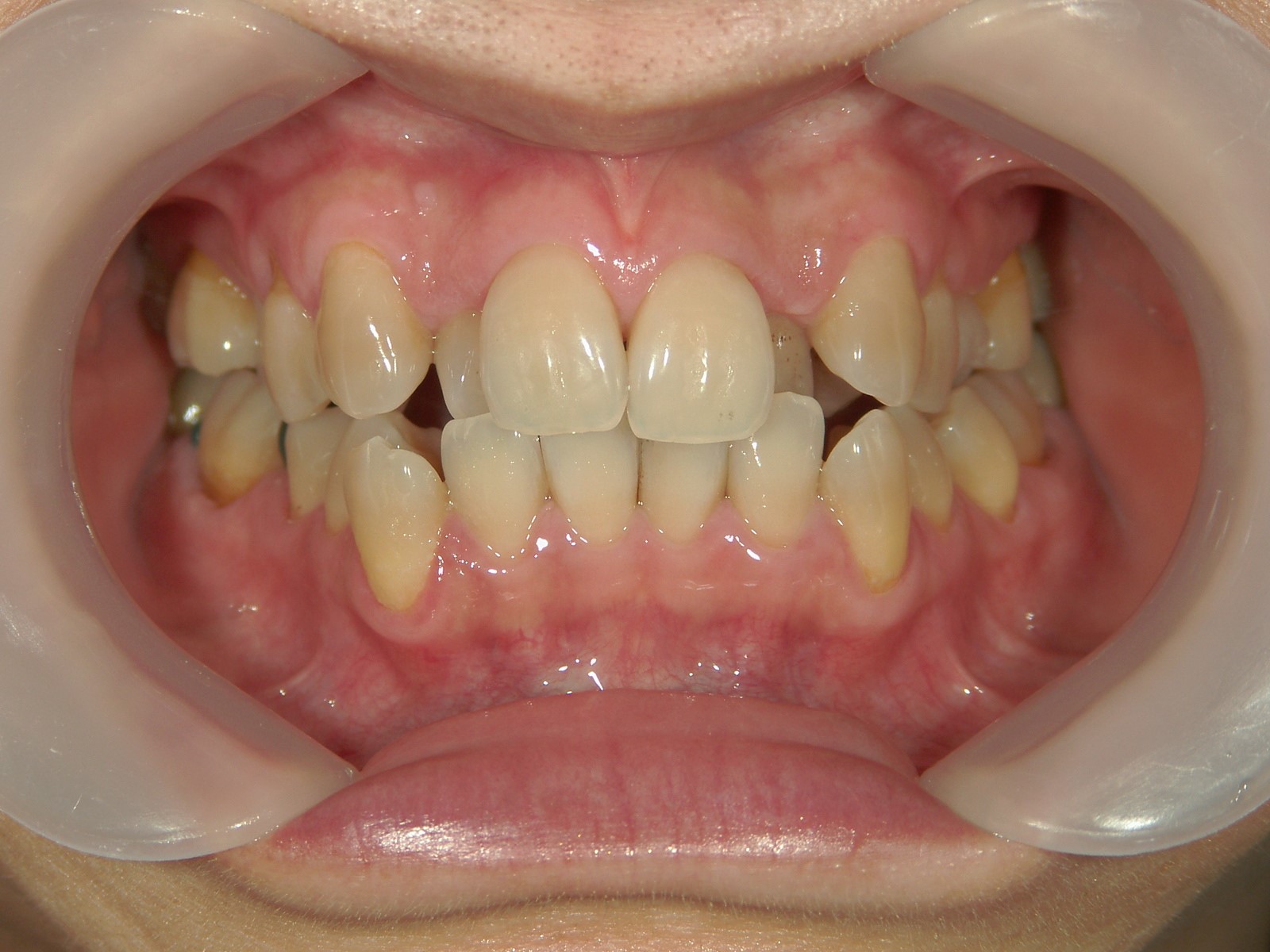 非抜歯症例（8）