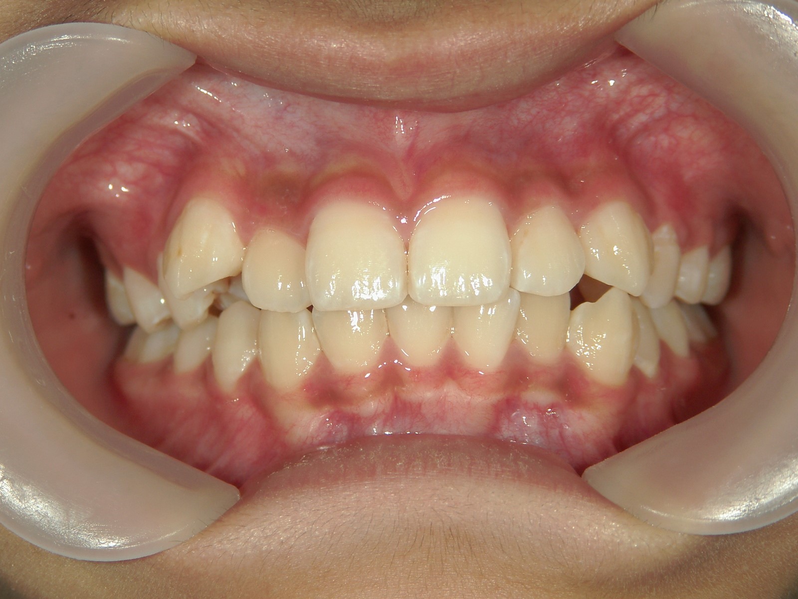 非抜歯症例（9）