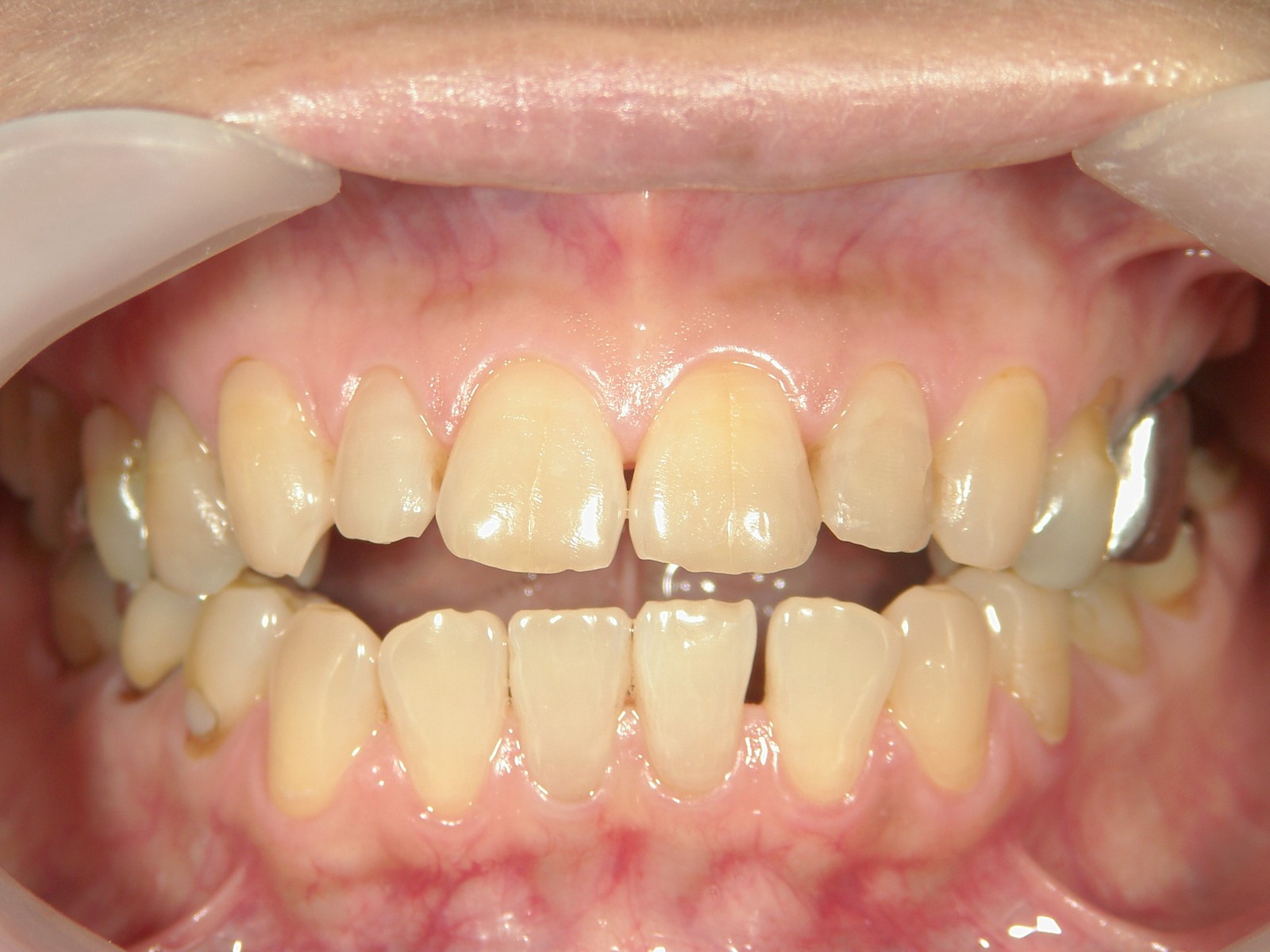 非抜歯症例（10）