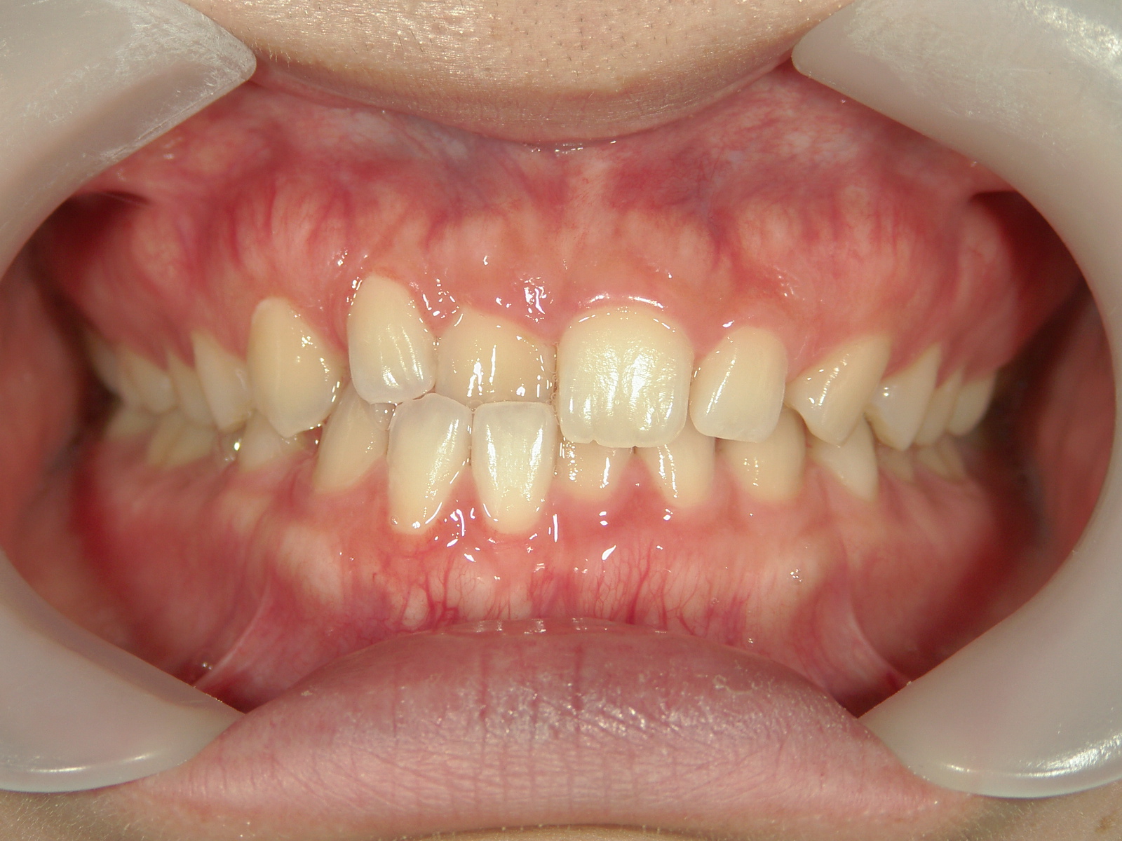 非抜歯症例（13）