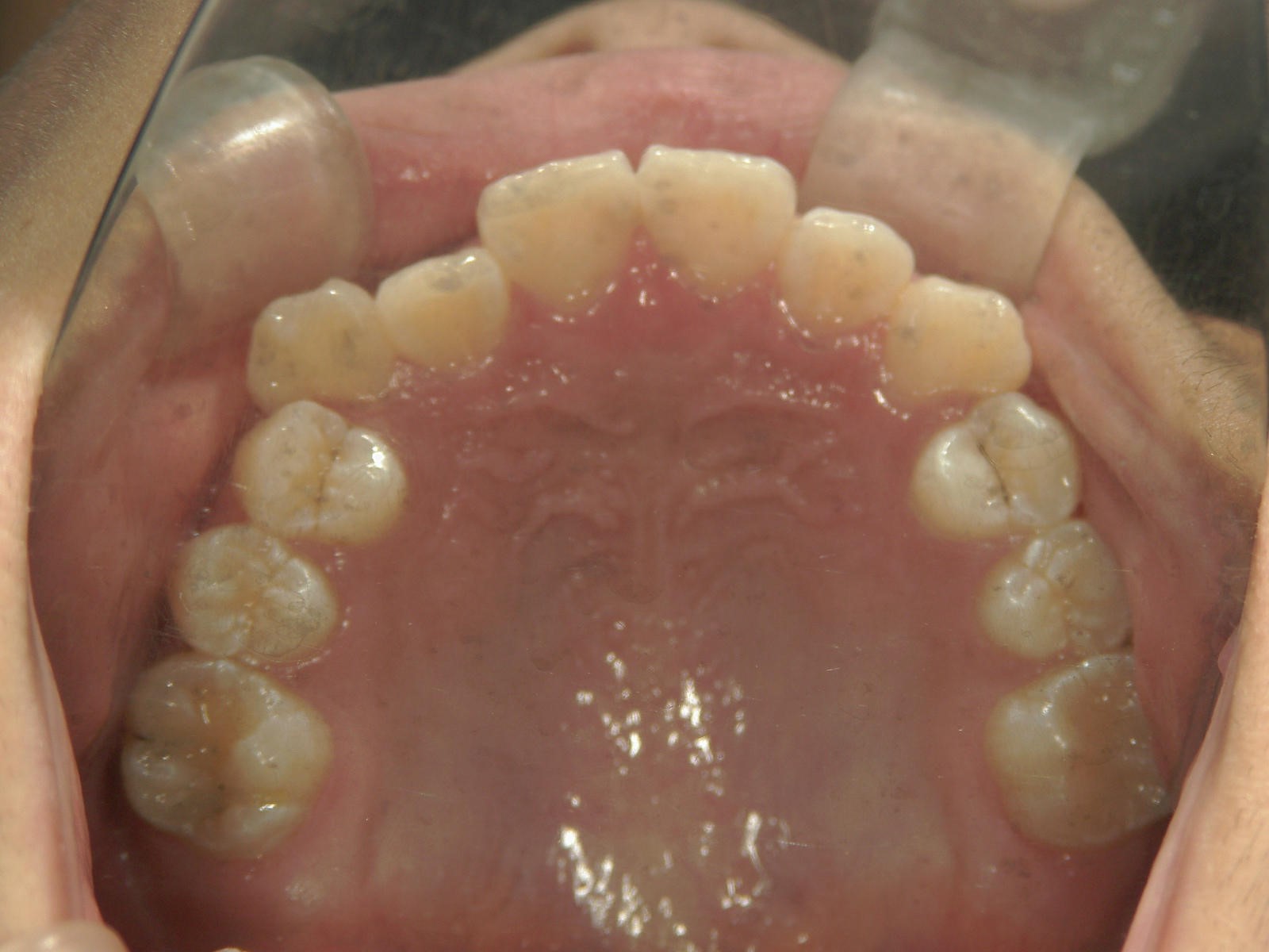 非抜歯症例（9）