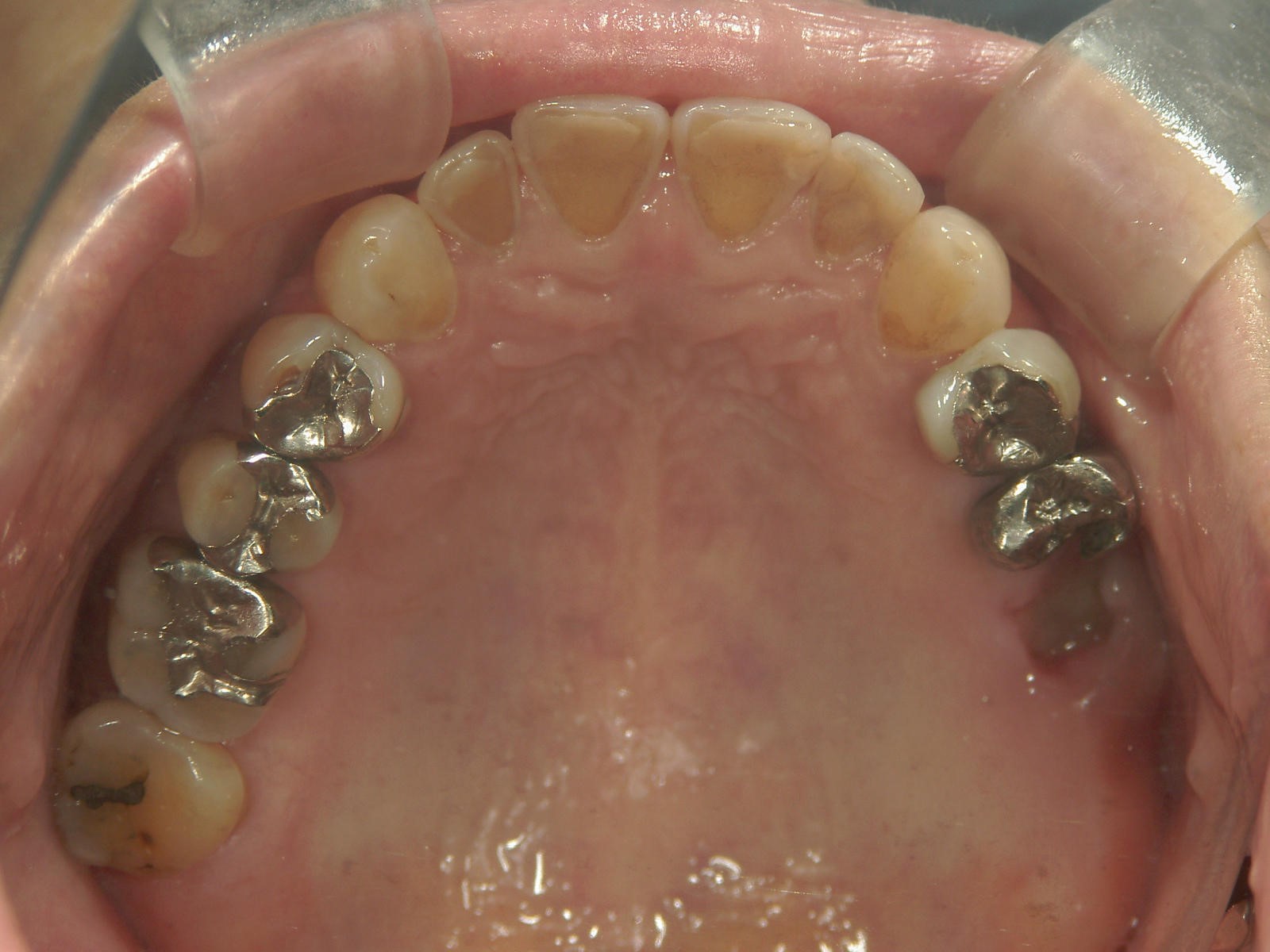 非抜歯症例（10）