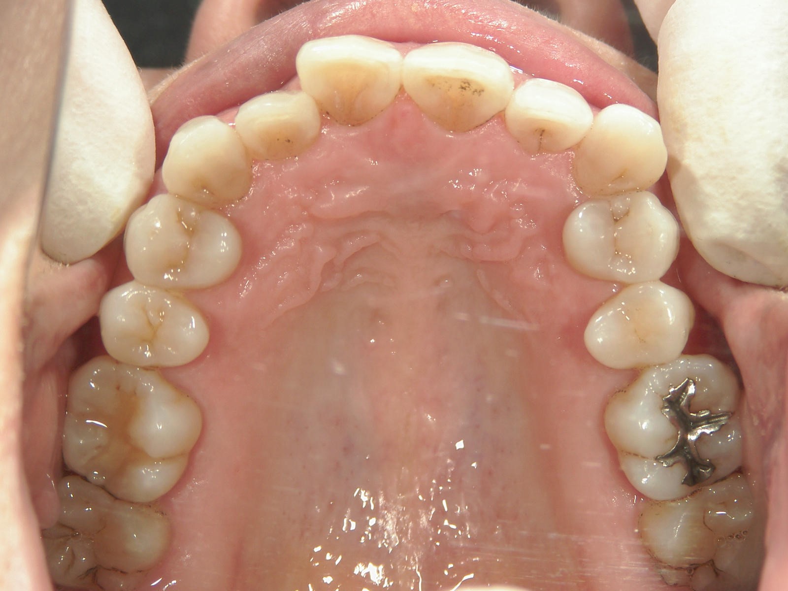 非抜歯症例（12）