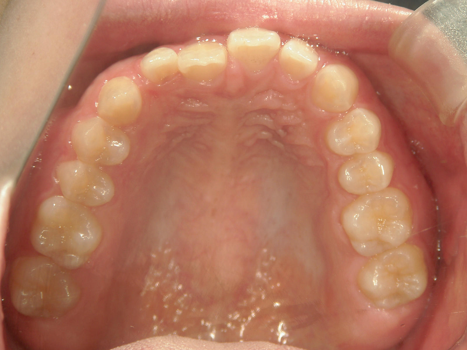 非抜歯症例（13）