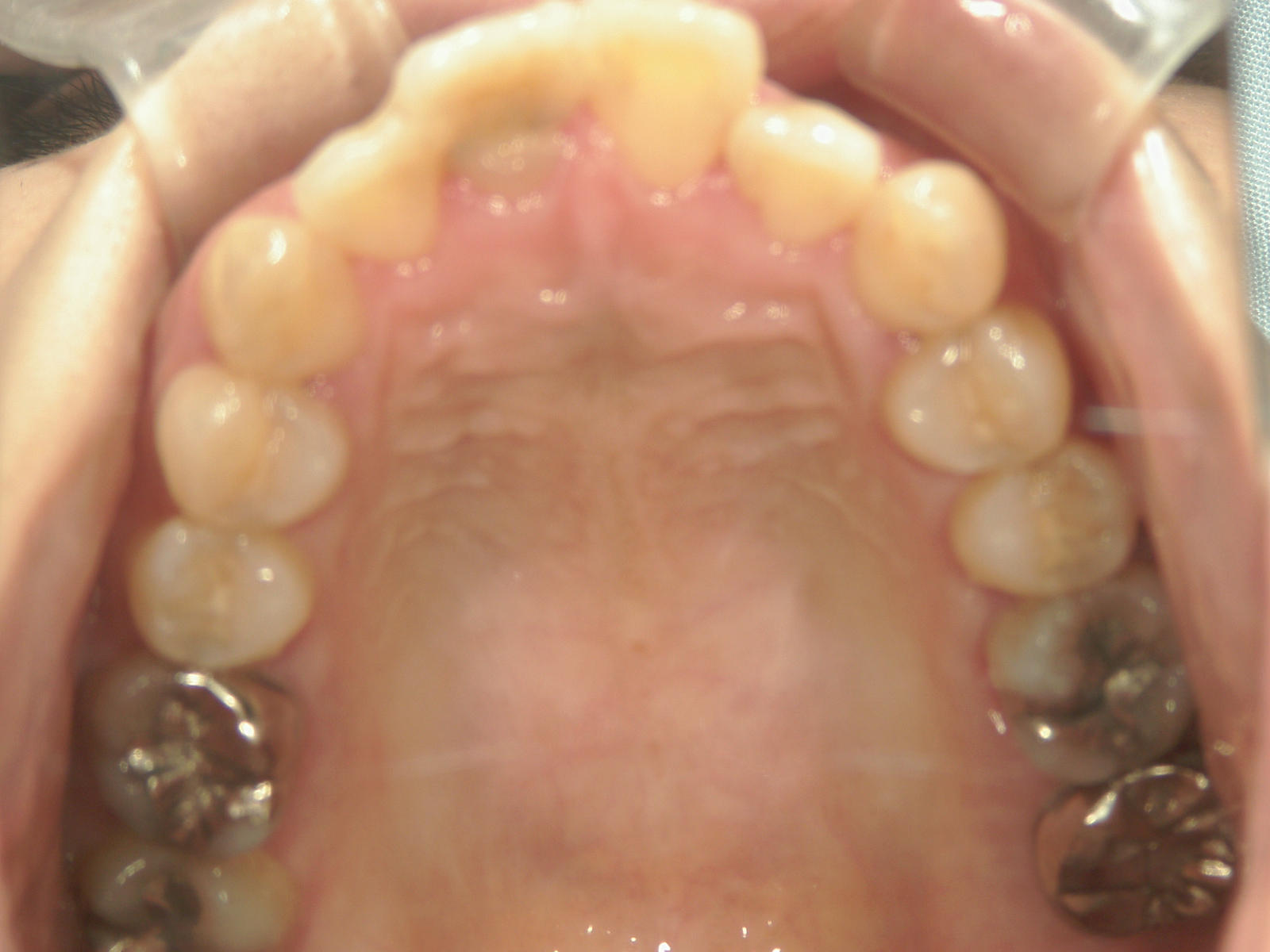 全顎ワイヤー矯正　症例（70）