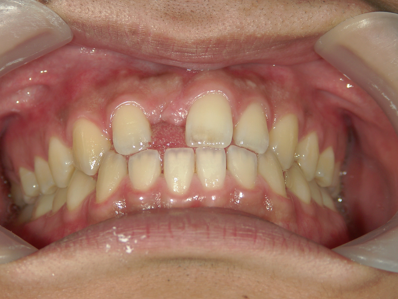 全顎ワイヤー矯正　症例（69）