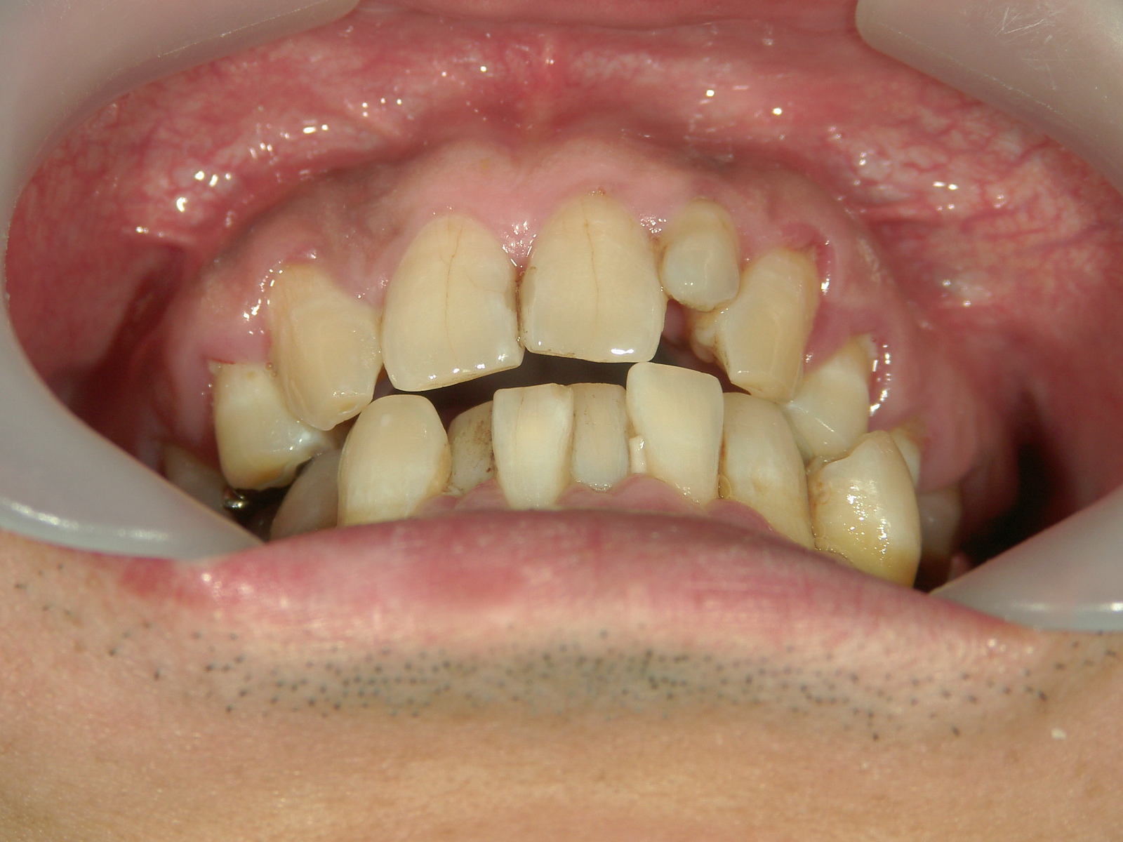 全顎ワイヤー矯正　症例（72）