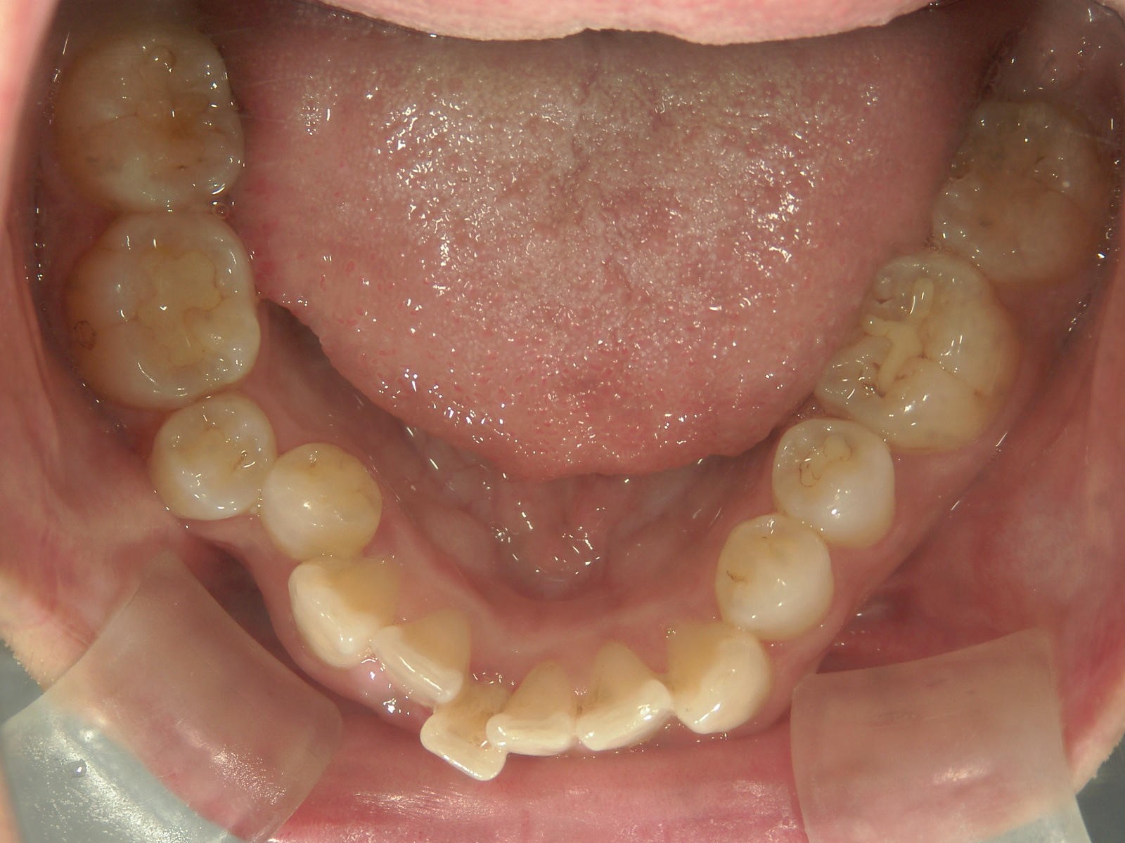 非抜歯症例（7）
