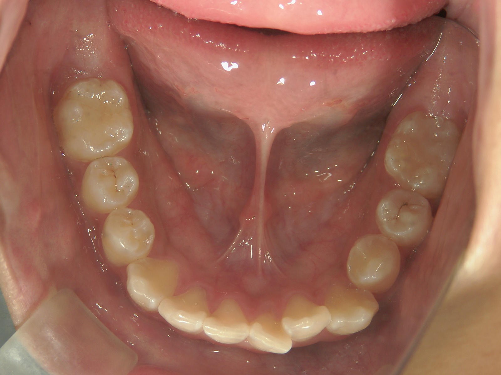 非抜歯症例（9）