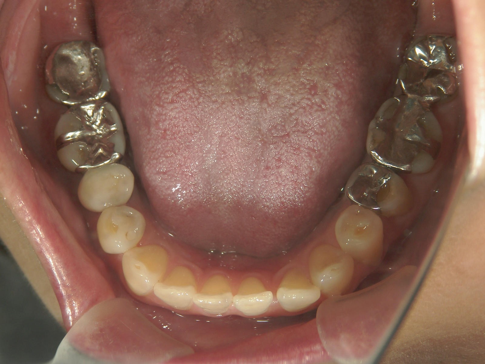 非抜歯症例（10）