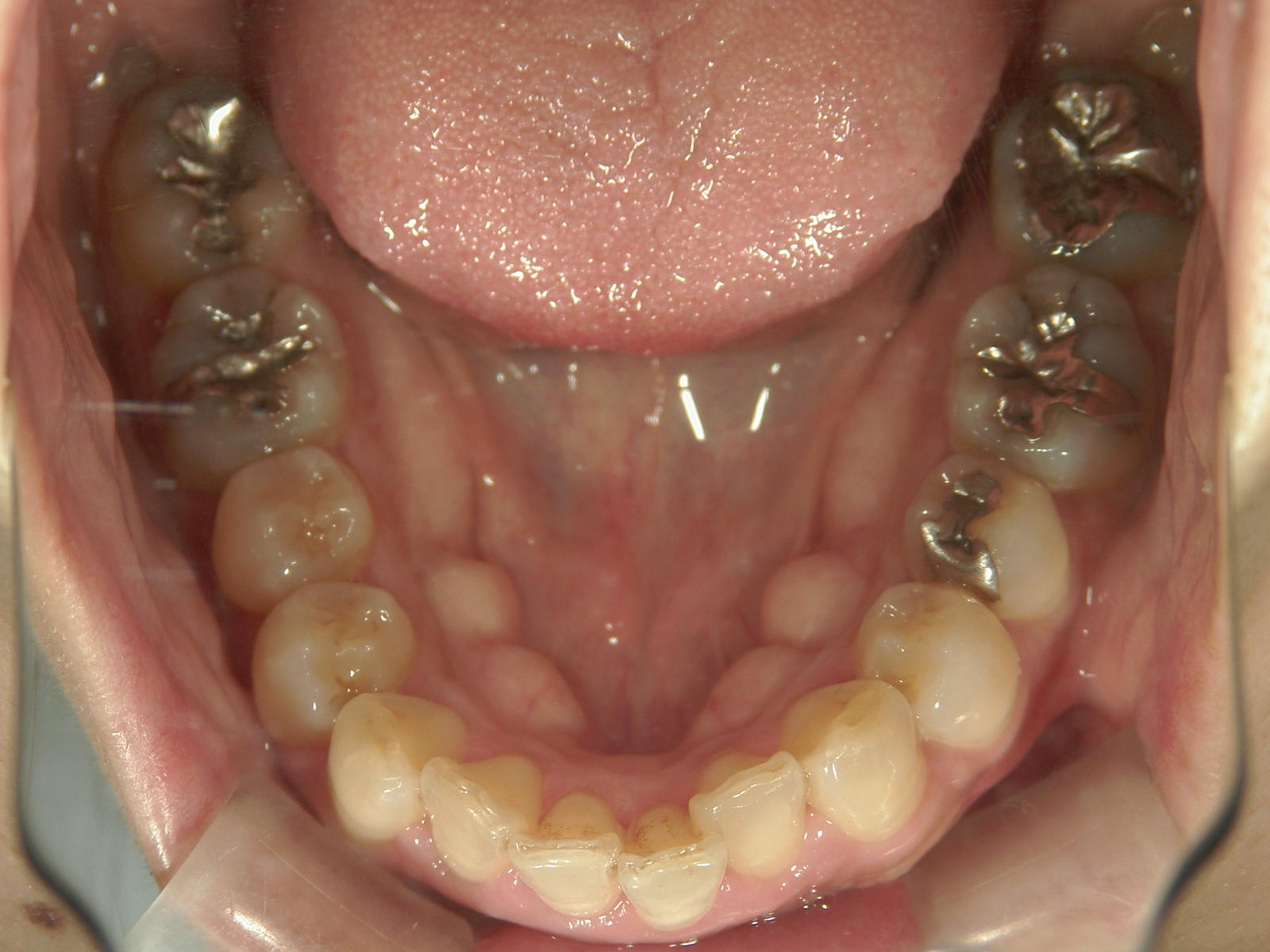 全顎ワイヤー矯正　症例（70）