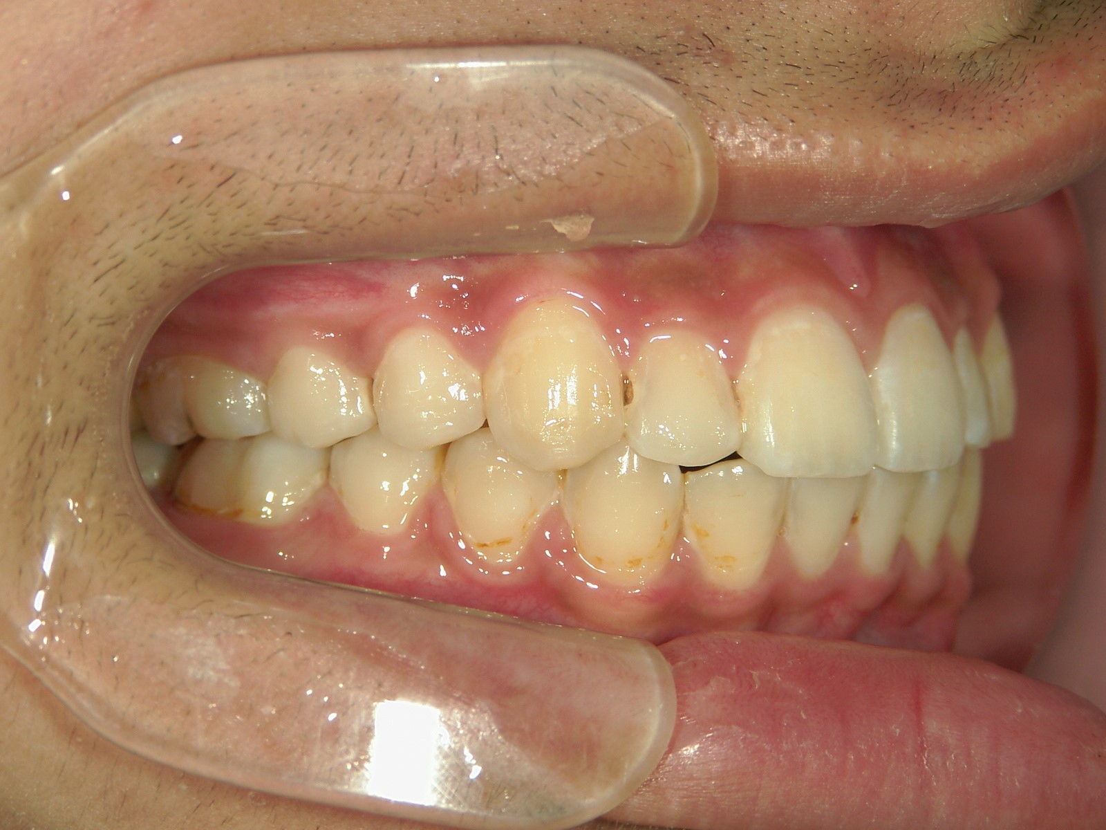 非抜歯症例（9）