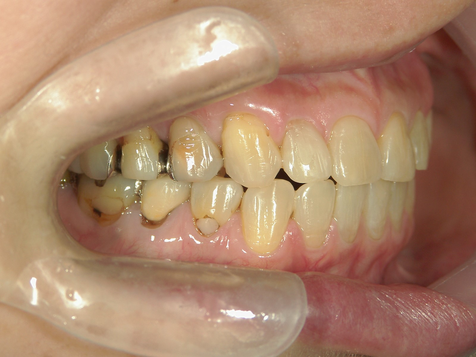 非抜歯症例（10）