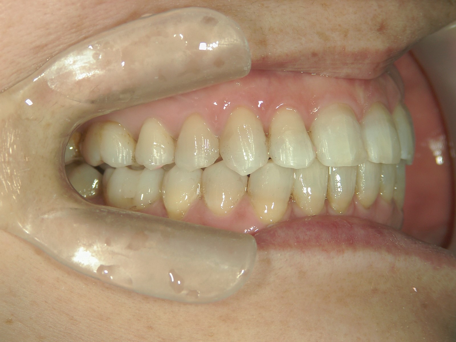 非抜歯症例（12）