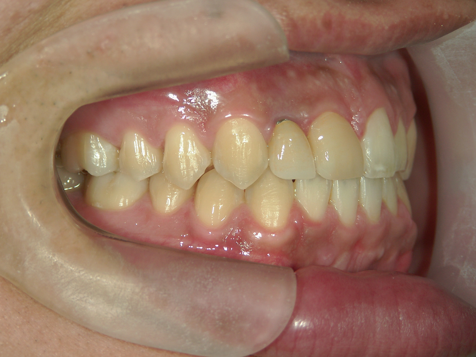 全顎ワイヤー矯正　症例（69）