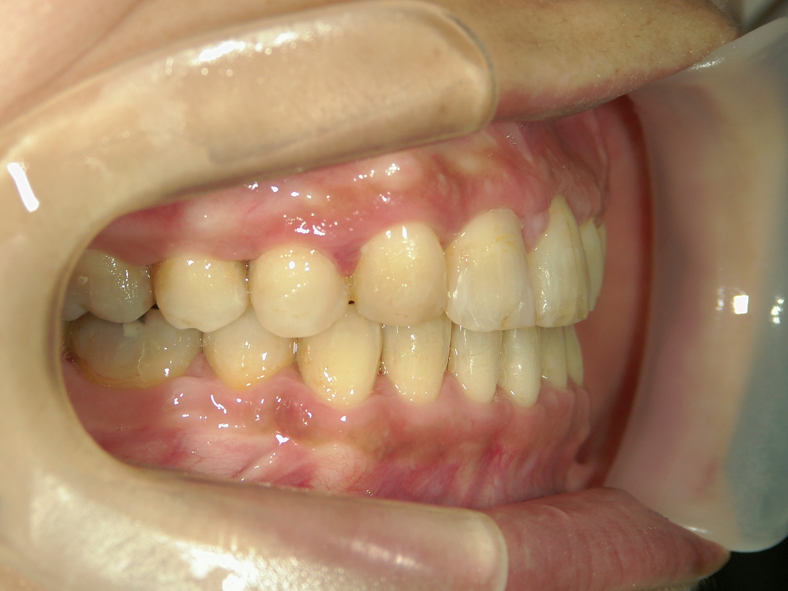 全顎ワイヤー矯正　症例（70）