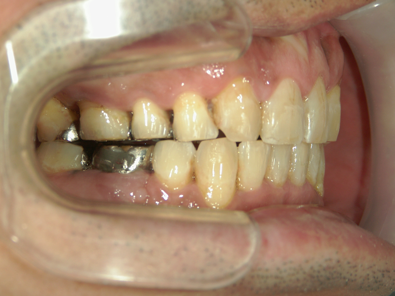 全顎ワイヤー矯正　症例（72）