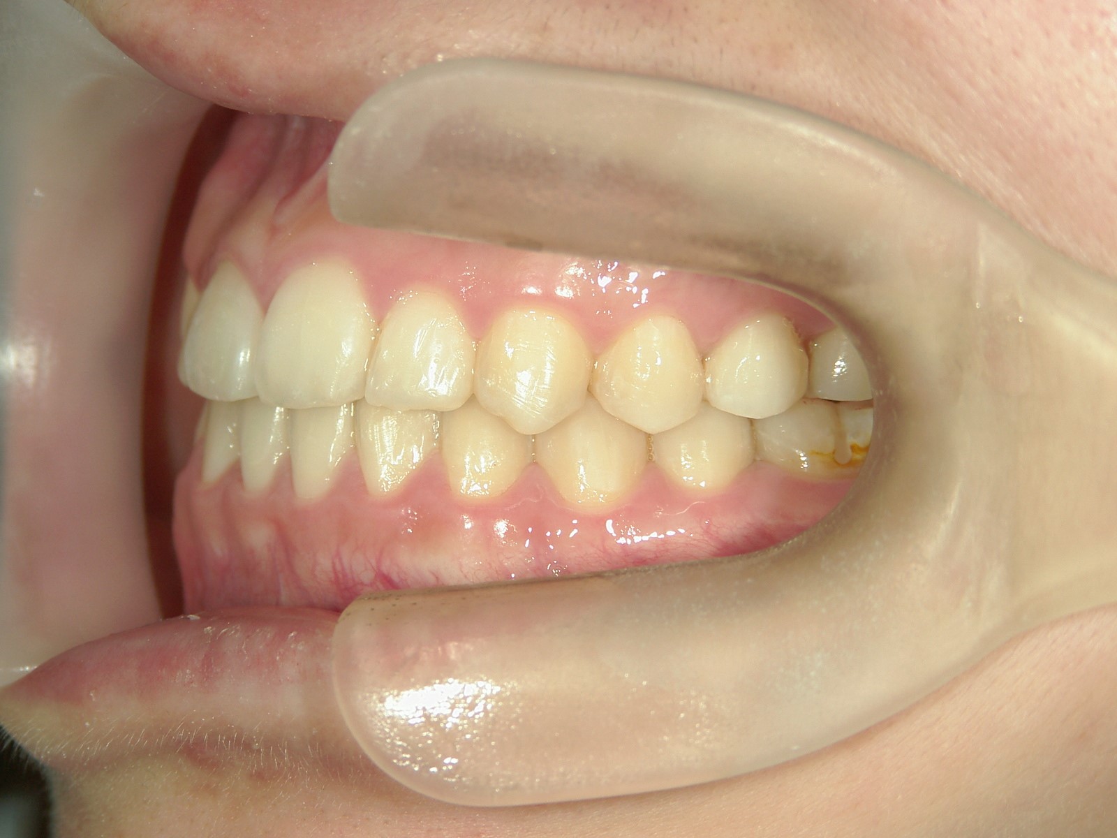 非抜歯症例（4）