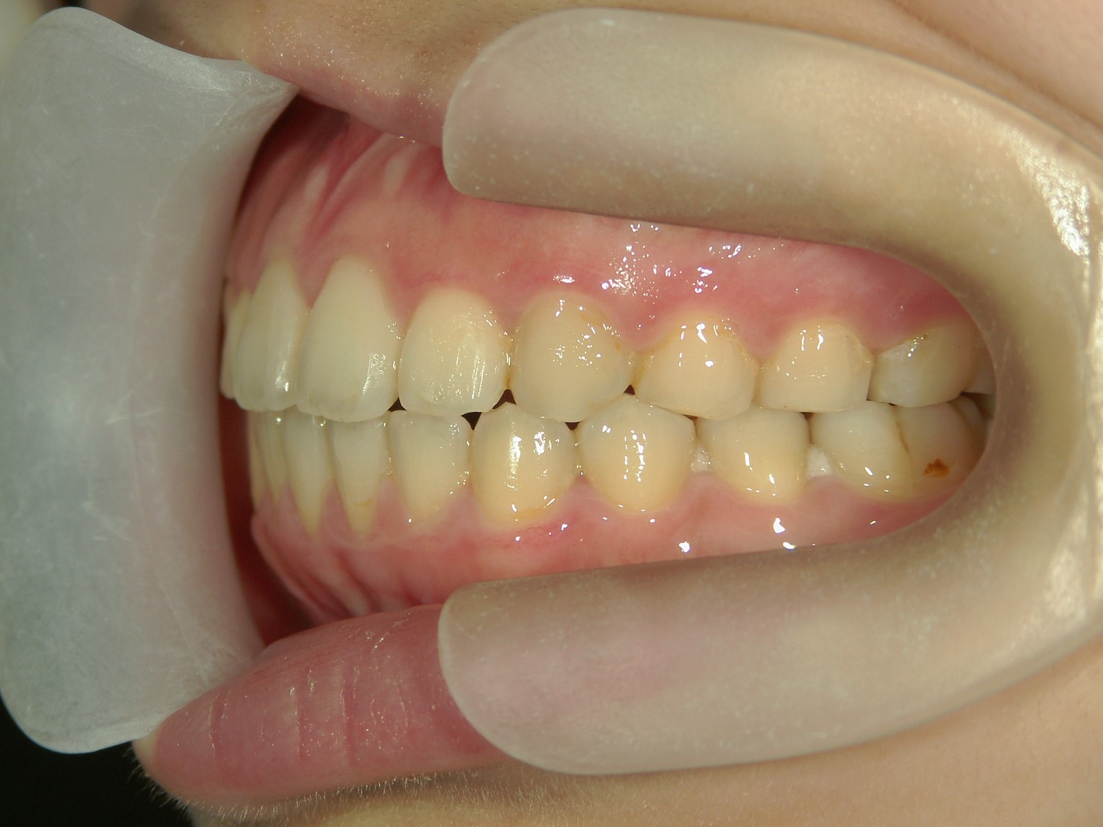 非抜歯症例（5）