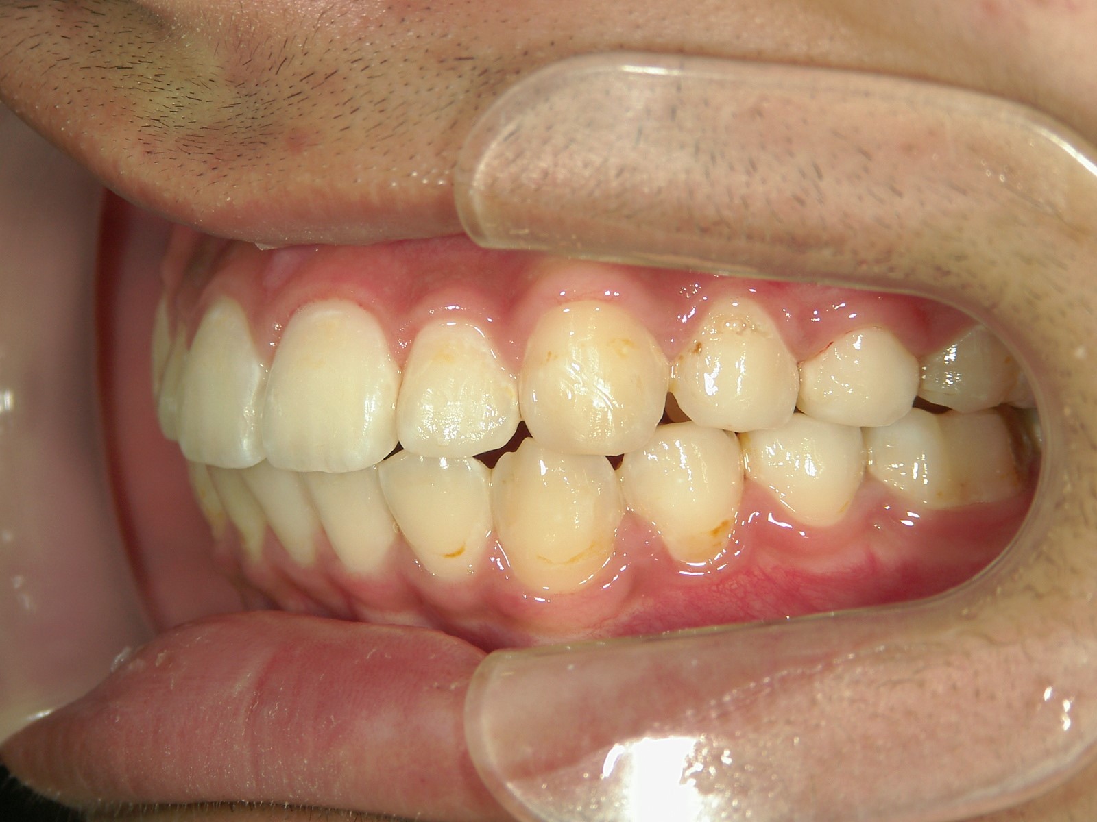 非抜歯症例（9）