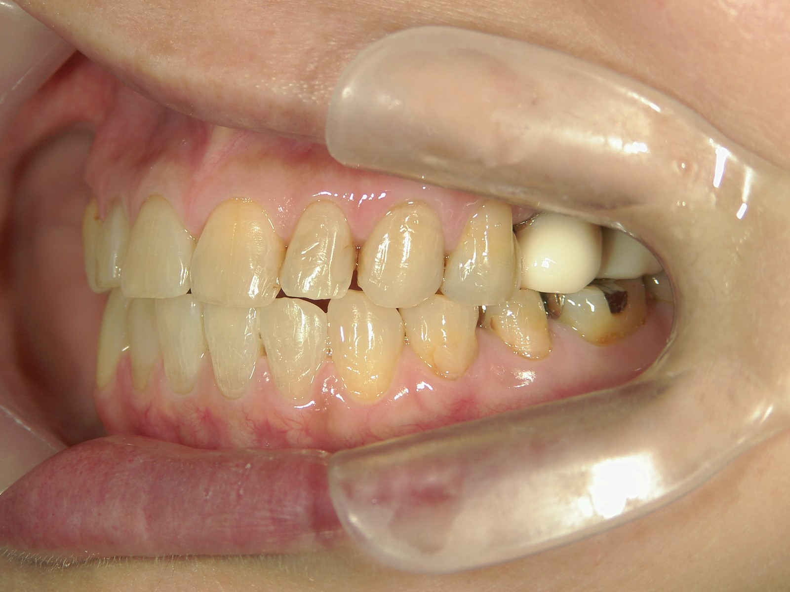 非抜歯症例（10）