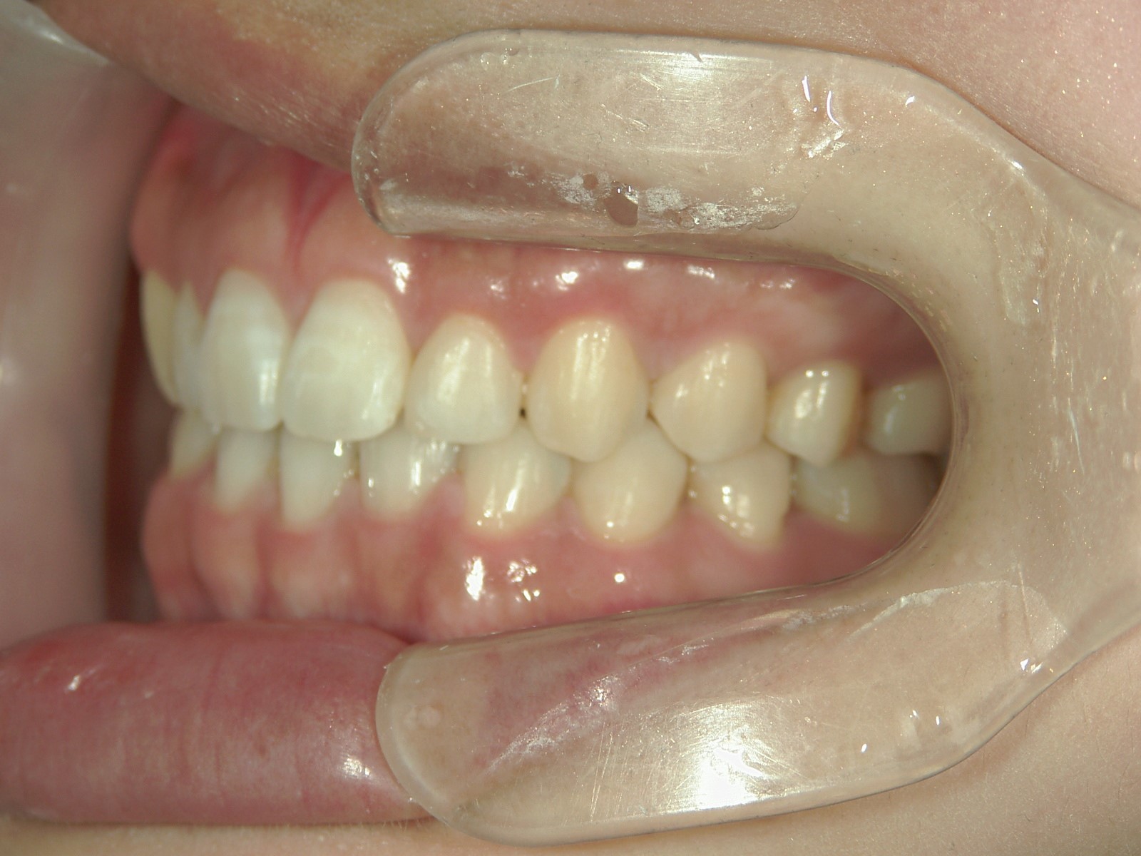 非抜歯症例（11）