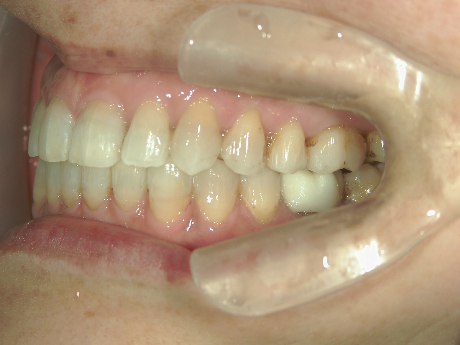 非抜歯症例（12）