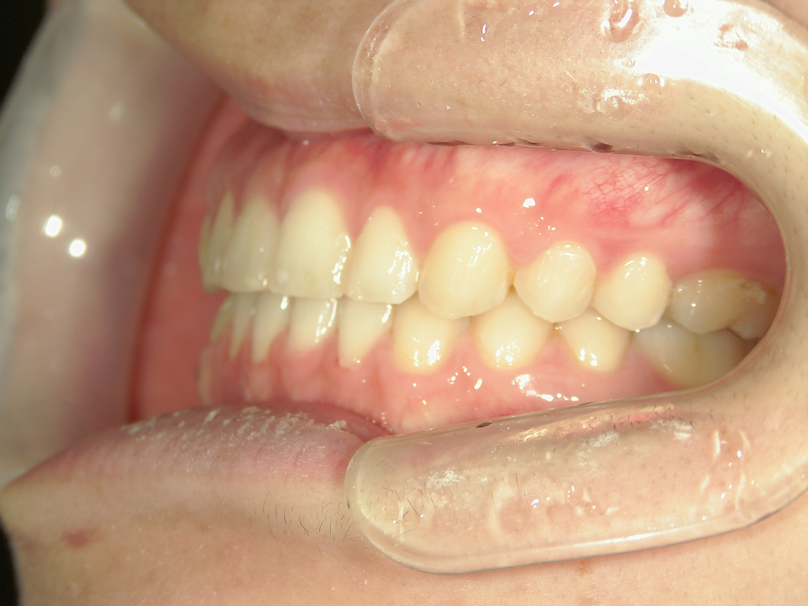 非抜歯症例（13）