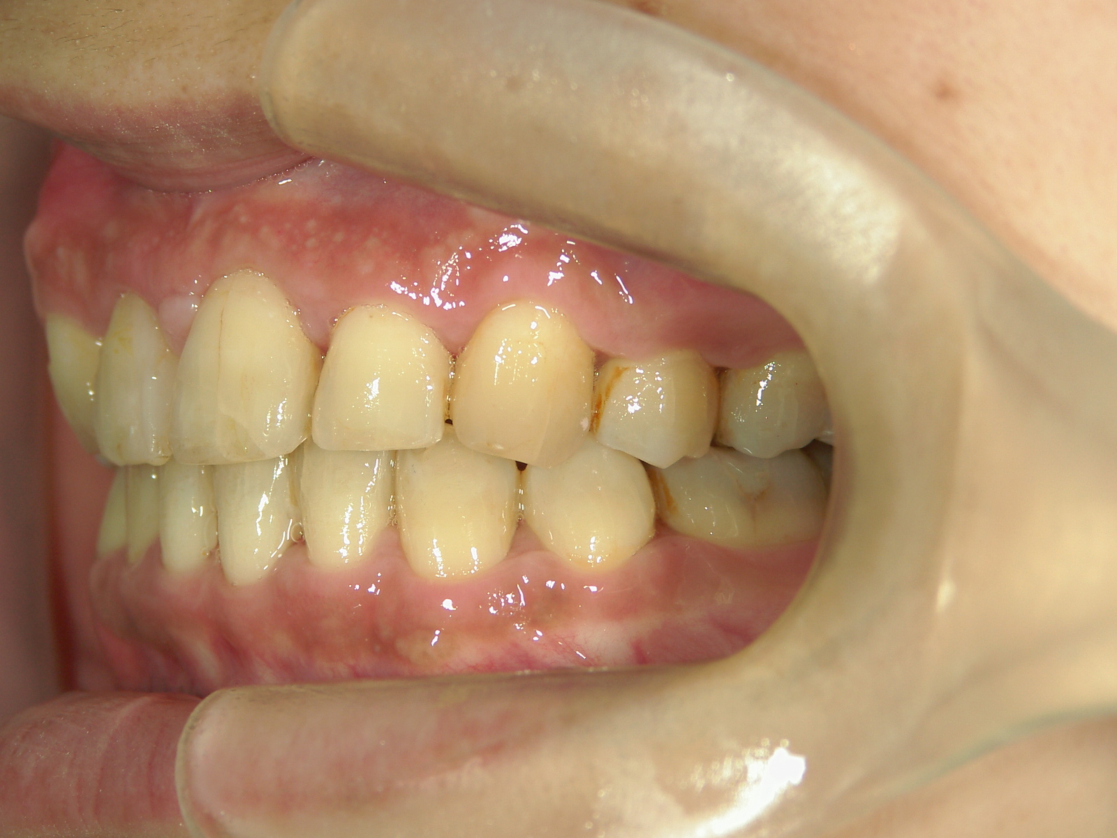 全顎ワイヤー矯正　症例（70）