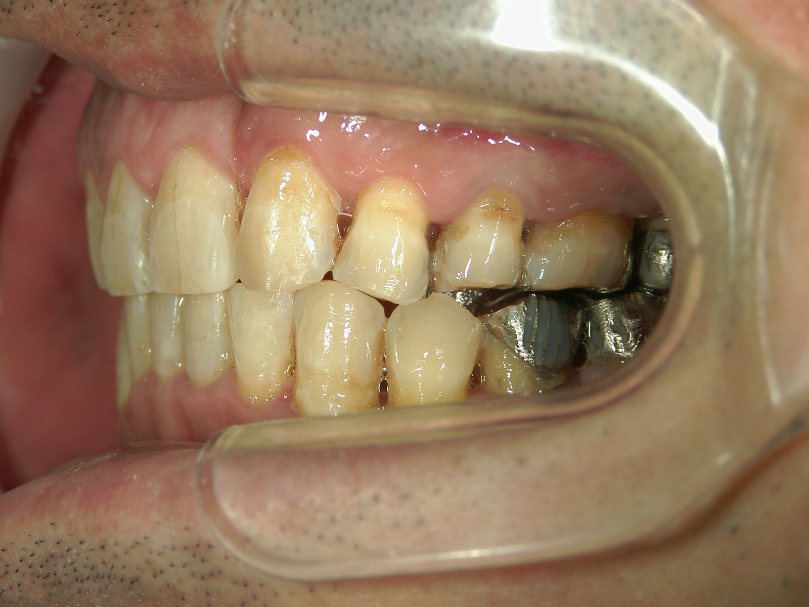 全顎ワイヤー矯正　症例（72）