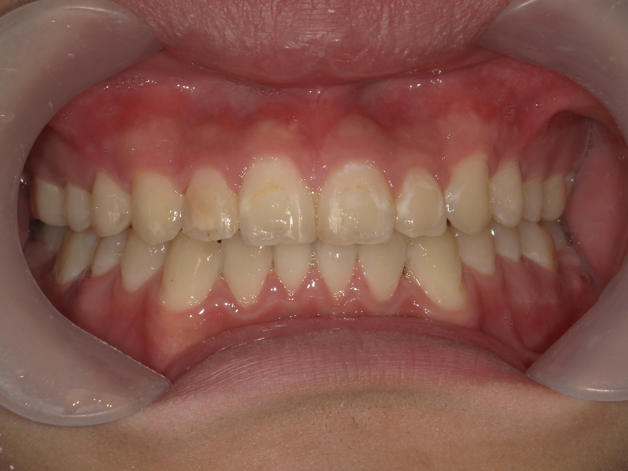 非抜歯症例（1）