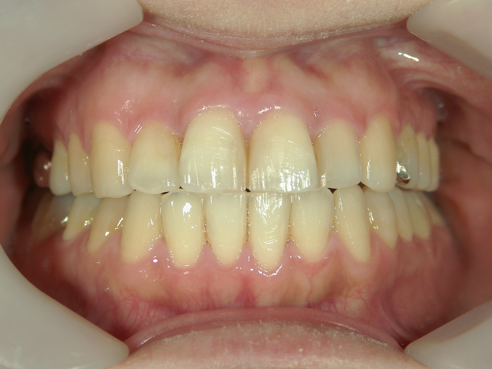 非抜歯症例（6）