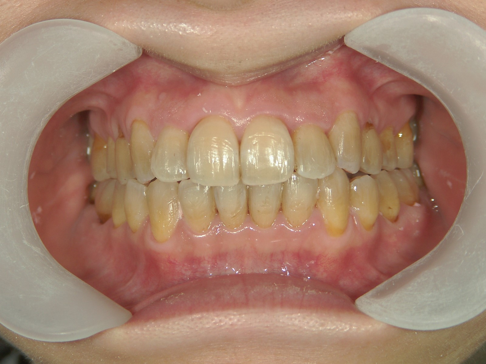 非抜歯症例（8）