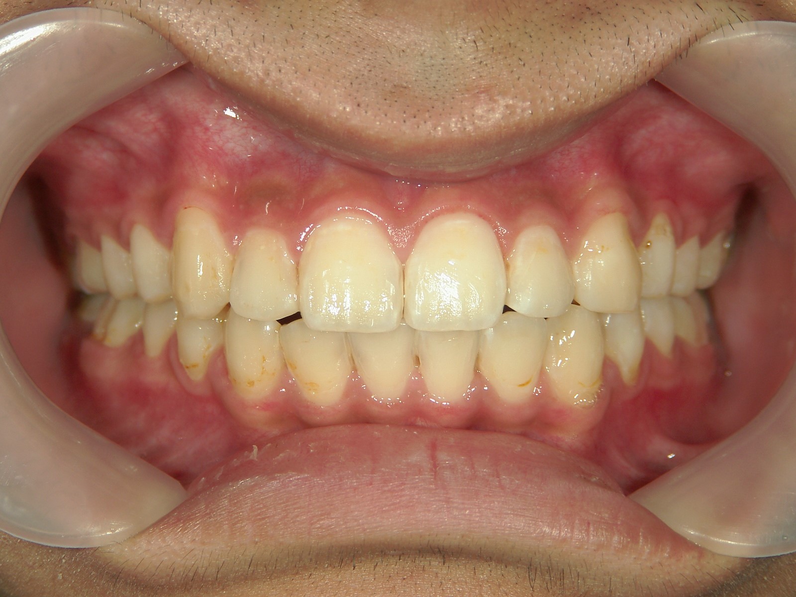 非抜歯症例（9）